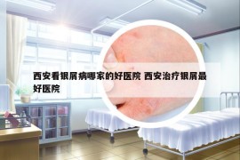 西安看銀屑病哪家的好醫(yī)院 西安治療銀屑最好醫(yī)院
