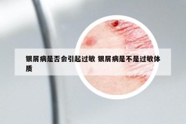 銀屑病是否會引起過敏 銀屑病是不是過敏體質(zhì)