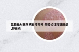 氟輕松對銀屑病有療效嗎 氟輕松訂對銀翹病,管用嗎