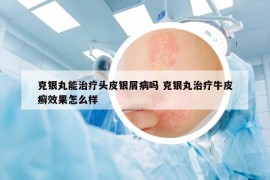 克銀丸能治療頭皮銀屑病嗎 克銀丸治療牛皮癬效果怎么樣