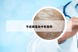 牛皮癬是血中有毒嗎