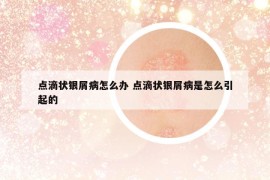 點(diǎn)滴狀銀屑病怎么辦 點(diǎn)滴狀銀屑病是怎么引起的