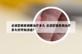點(diǎn)滴型銀屑病要治療多久 點(diǎn)滴型銀屑病治療多久好開始消退?