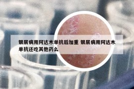 銀屑病用阿達(dá)木單抗后加重 銀屑病用阿達(dá)木單抗還吃其他藥么