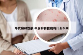 牛皮癬和性病 牛皮癬和性病有什么不同