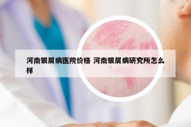 河南銀屑病醫(yī)院價(jià)格 河南銀屑病研究所怎么樣