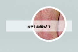 治療牛皮癬的方子