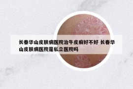 長春華山皮膚病醫(yī)院治牛皮癬好不好 長春華山皮膚病醫(yī)院是私立醫(yī)院嗎