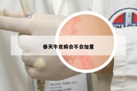 春天牛皮癬會不會加重