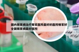 國(guó)內(nèi)銀屑病治療那家醫(yī)院最好的醫(yī)院哪家好 全國(guó)銀屑病最好醫(yī)院