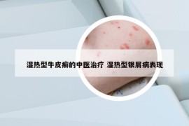 濕熱型牛皮癬的中醫(yī)治療 濕熱型銀屑病表現(xiàn)