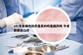 otc牛皮癬吃的藥是真的嗎是國藥嗎 牛皮膚癬進(jìn)口藥