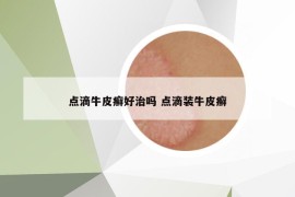 點滴牛皮癬好治嗎 點滴裝牛皮癬