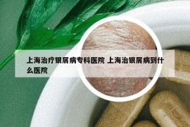 上海治療銀屑病?？漆t(yī)院 上海治銀屑病到什么醫(yī)院
