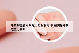 牛皮癬患者可以吃三七石斛嗎 牛皮膚癬可以吃三七粉嗎