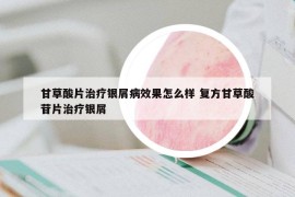 甘草酸片治療銀屑病效果怎么樣 復(fù)方甘草酸苷片治療銀屑