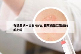 有銀屑病一定有HIV么 銀屑病是艾滋病的前兆嗎