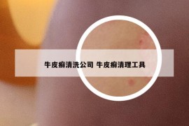 牛皮癬清洗公司 牛皮癬清理工具