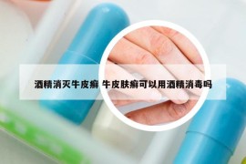 酒精消滅牛皮癬 牛皮膚癬可以用酒精消毒嗎