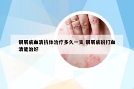 銀屑病血清抗體治療多久一支 銀屑病說打血清能治好