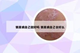 銀屑病自己回好嗎 銀屑病自己會(huì)好么