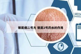 銀屑病二號方 銀屑2號藥水的作用