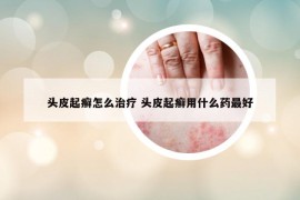 頭皮起癬怎么治療 頭皮起癬用什么藥最好