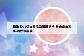 維生素d3衍生物能治銀屑病嗎 補(bǔ)充維生素d3治療銀屑病