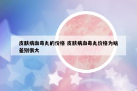 皮膚病血毒丸的價(jià)格 皮膚病血毒丸價(jià)格為啥差別很大
