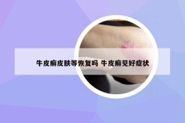 牛皮癬皮膚等恢復(fù)嗎 牛皮癬見(jiàn)好癥狀