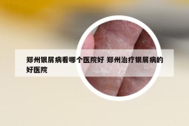 鄭州銀屑病看哪個(gè)醫(yī)院好 鄭州治療銀屑病的好醫(yī)院