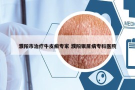 濮陽(yáng)市治療牛皮癬專家 濮陽(yáng)銀屑病?？漆t(yī)院