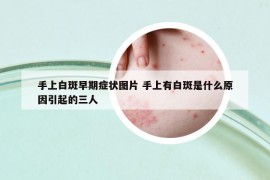 手上白斑早期癥狀圖片 手上有白斑是什么原因引起的三人