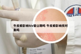 牛皮癬影響hiv窗口期嗎 牛皮癬影響找對(duì)象嗎