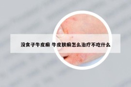 沒食子牛皮癬 牛皮膚癬怎么治療不吃什么