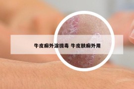 牛皮癬外涂拔毒 牛皮膚癬外用