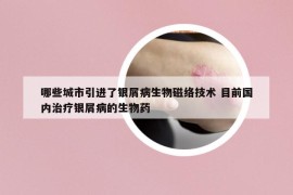 哪些城市引進了銀屑病生物磁絡(luò)技術(shù) 目前國內(nèi)治療銀屑病的生物藥