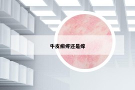 牛皮癬疼還是癢