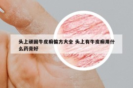 頭上頑固牛皮癬偏方大全 頭上有牛皮癬用什么藥膏好