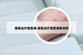 蒺藜治療銀屑病 蒺藜治療銀屑病有效嗎