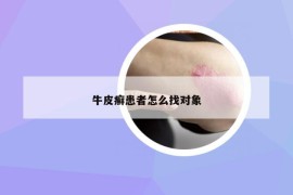 牛皮癬患者怎么找對(duì)象