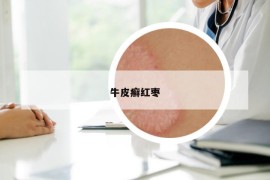 牛皮癬紅棗