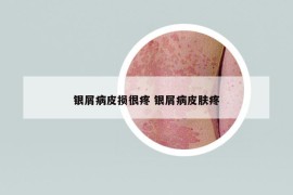 銀屑病皮損很疼 銀屑病皮膚疼