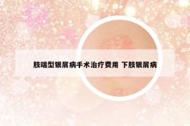 肢端型銀屑病手術(shù)治療費(fèi)用 下肢銀屑病