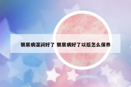 銀屑病濕潤好了 銀屑病好了以后怎么保養(yǎng)