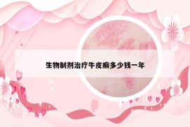 生物制劑治療牛皮癬多少錢一年