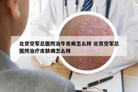 北京空軍總醫(yī)院治牛皮癬怎么樣 北京空軍總醫(yī)院治療皮膚病怎么樣