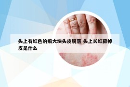 頭上有紅色的癬大塊頭皮脫落 頭上長紅蘚掉皮是什么