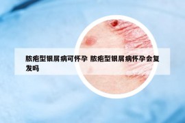 膿皰型銀屑病可懷孕 膿皰型銀屑病懷孕會(huì)復(fù)發(fā)嗎