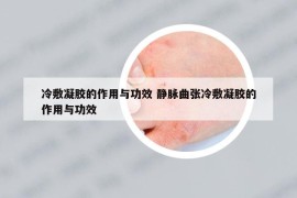冷敷凝膠的作用與功效 靜脈曲張冷敷凝膠的作用與功效